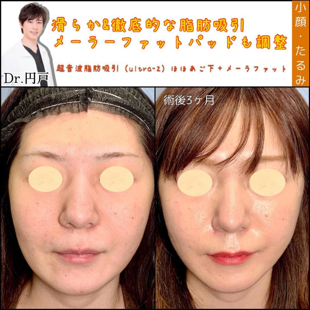 頬と顎下の脂肪吸引とメーラーファットの症例写真