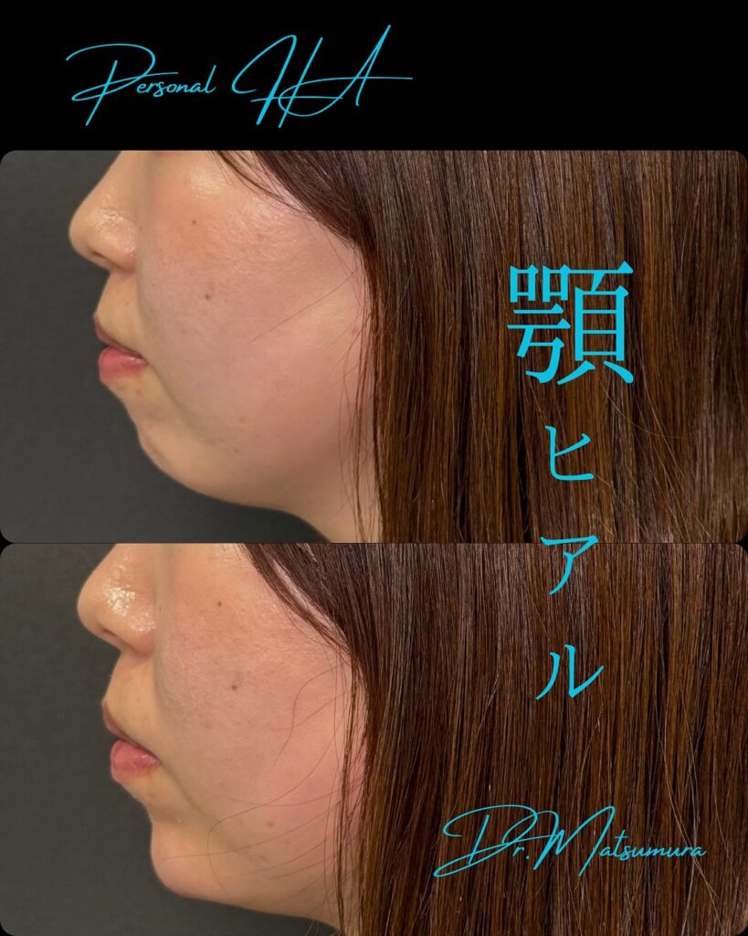 顎のヒアルロン酸の症例写真