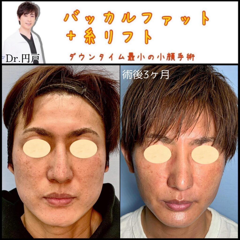 バッカルファットと糸リフトの症例写真 (5)