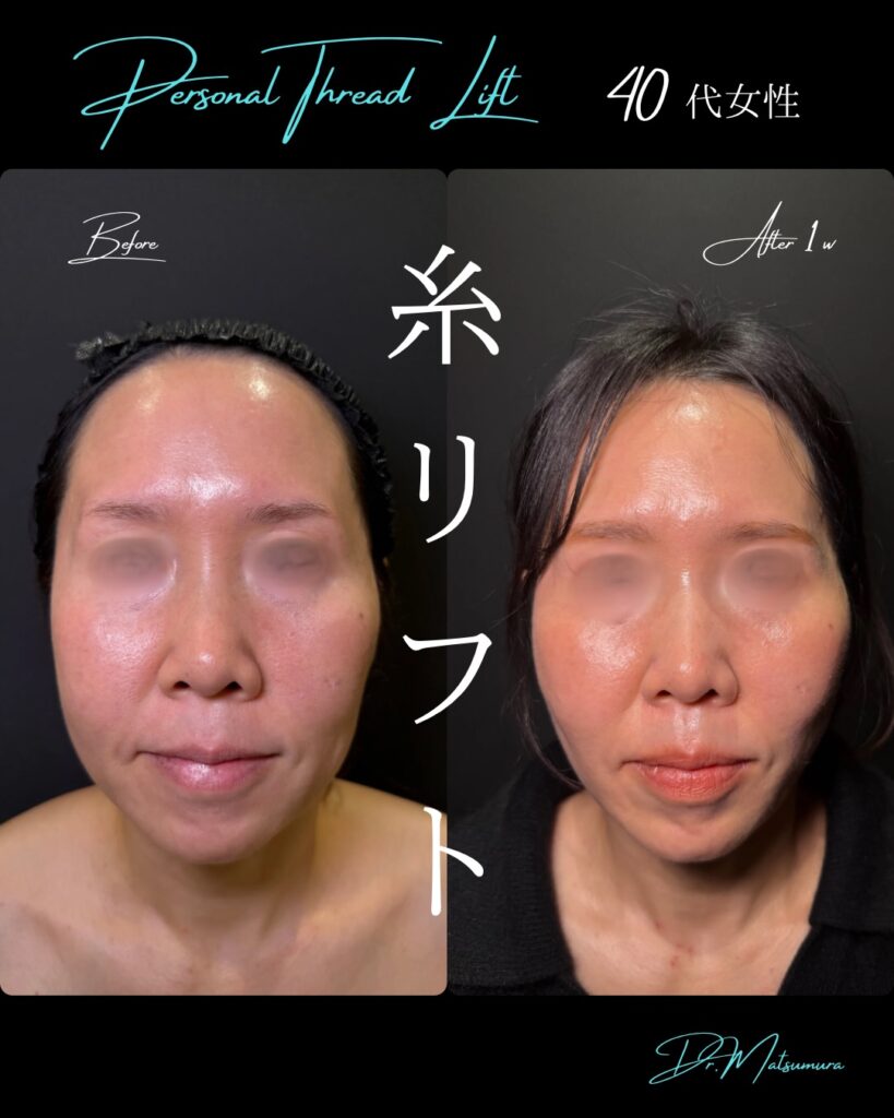 糸リフトの症例写真 (13)