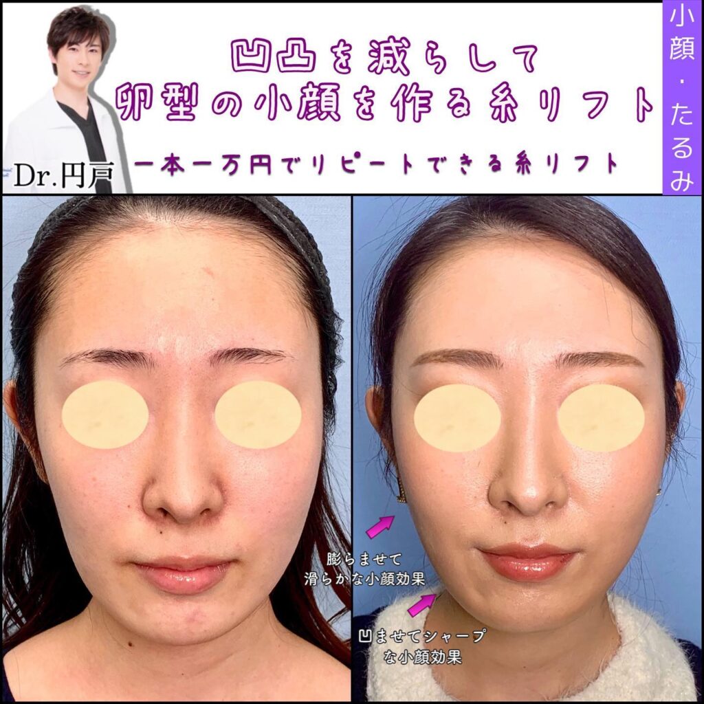 糸リフトの症例写真 (13)