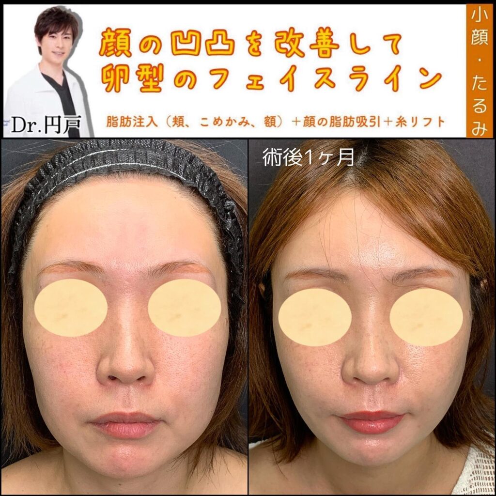 ほほとこめかみの脂肪注入と顔の脂肪吸引と糸リフトの症例写真