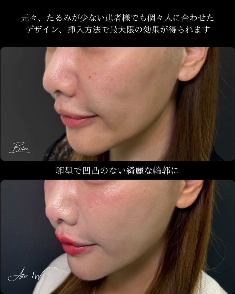 糸リフトとヒアルロン酸の症例写真 (1)