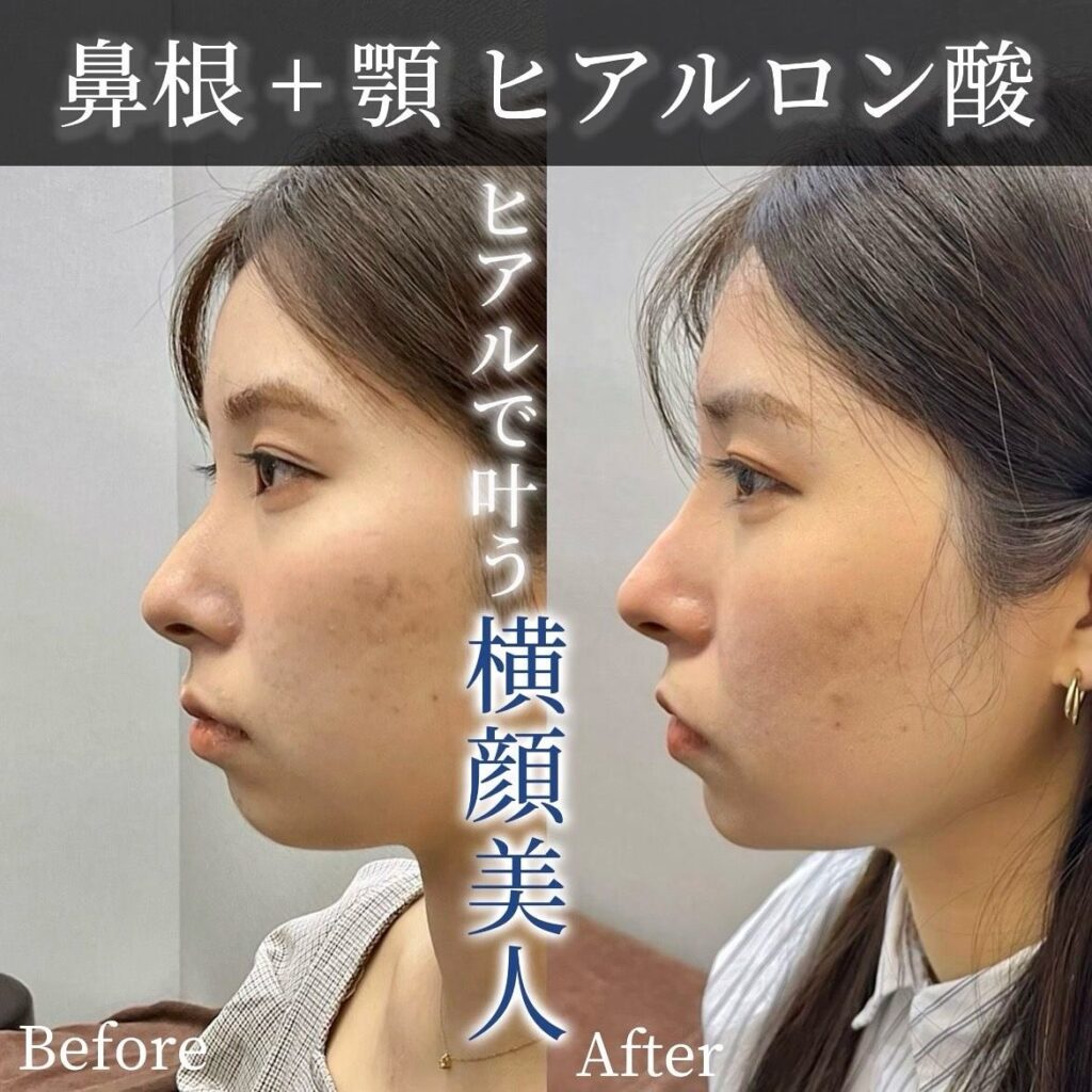 鼻筋と顎のヒアルロン酸の症例写真