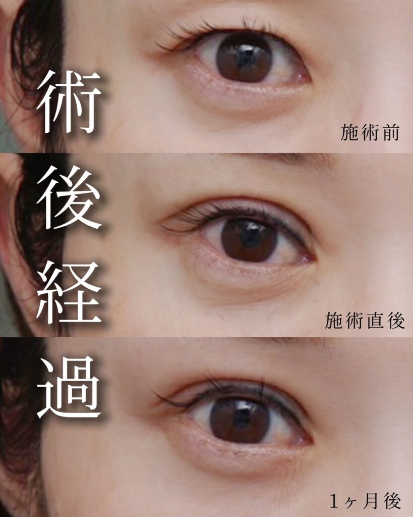 埋没法の症例写真 (10)