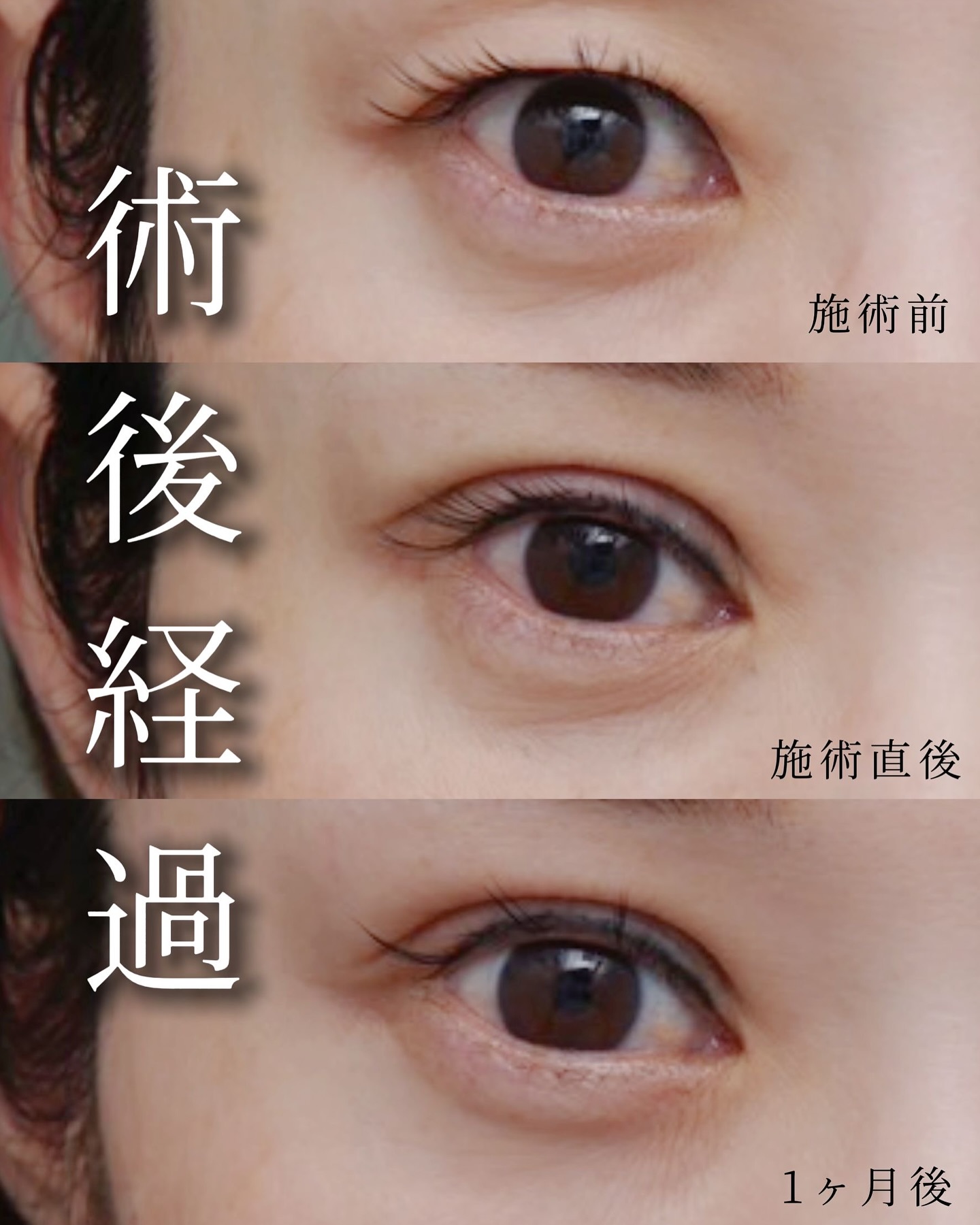 埋没法の症例写真 (10)