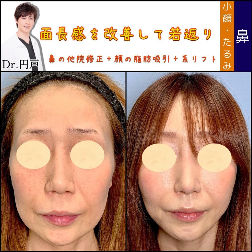 鼻の他院修正と顔の脂肪吸引と糸リフトの症例写真