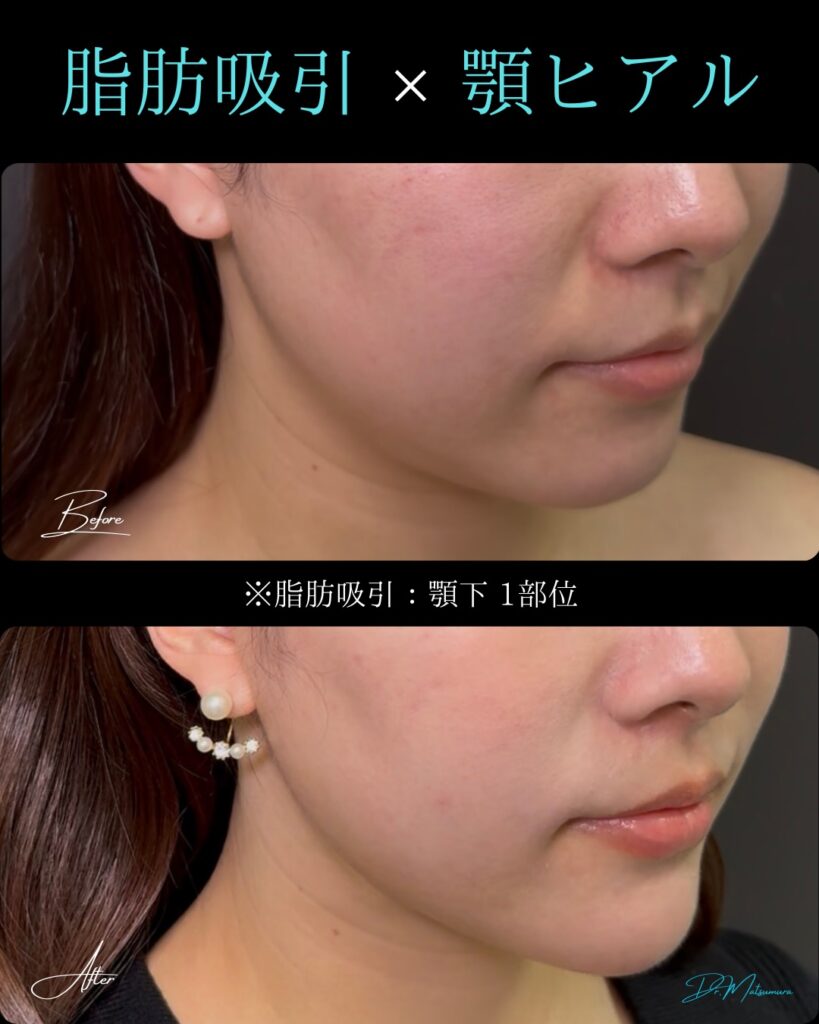 顔の脂肪吸引と顎のヒアルロン酸の症例写真 (1)
