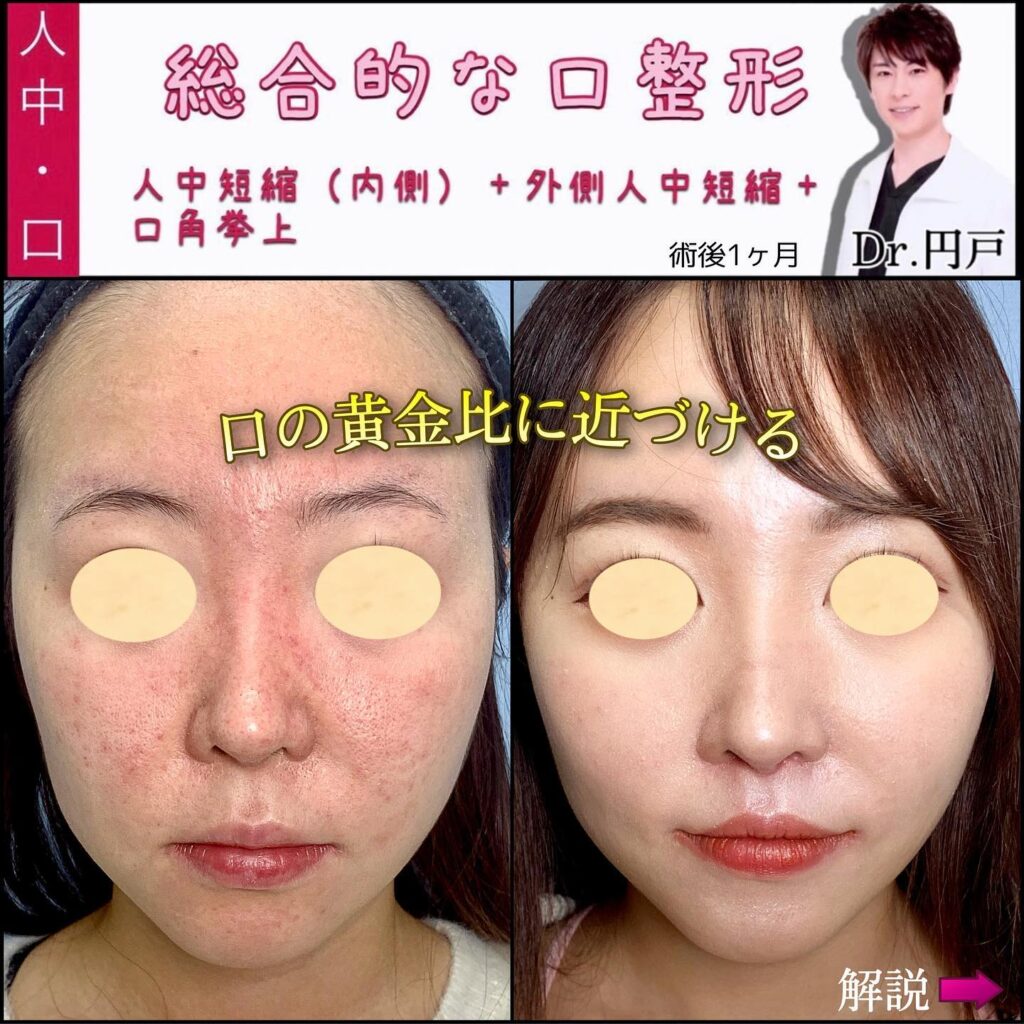 人中短縮と外側人中短縮と口角挙上の症例写真