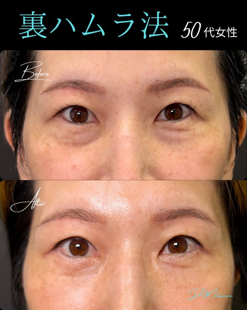 裏ハムラ法の症例写真 (19)