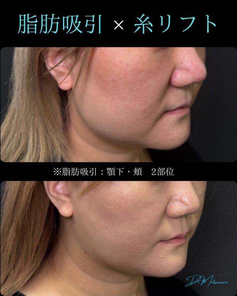 顔の脂肪吸引と糸リフトの症例写真 (6)
