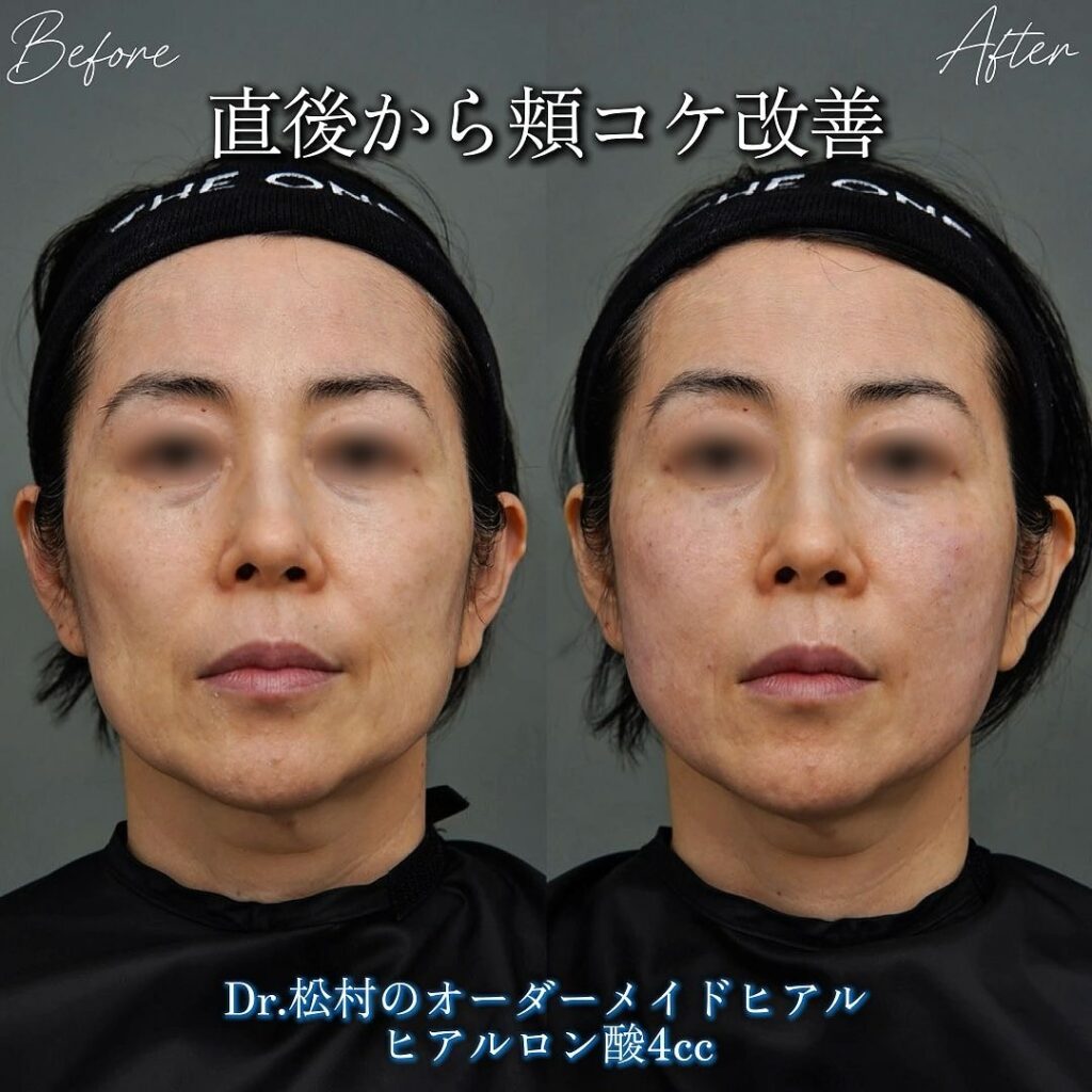 頬と目の下とほうれい線のヒアルロン酸注入の症例写真