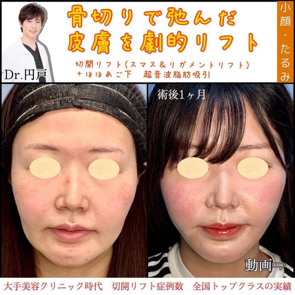 切開リフトと頬と顎下の脂肪吸引症例写真