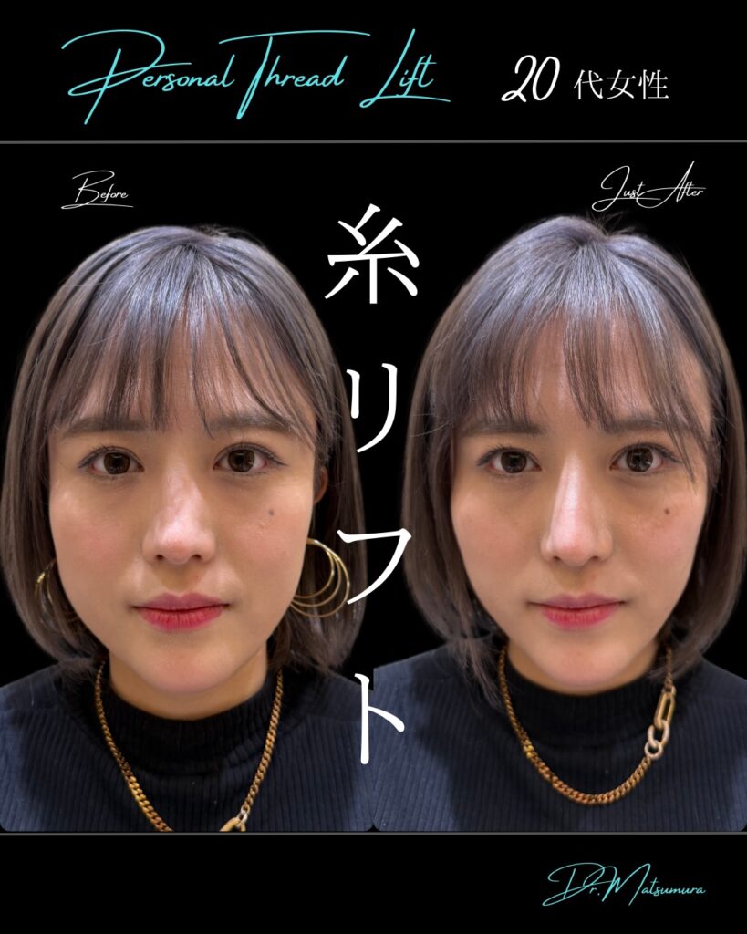 糸リフトの症例写真 (12)