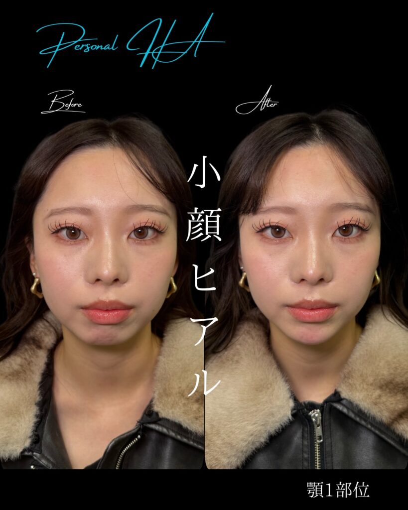 顎のヒアルロン酸の症例写真 (3)