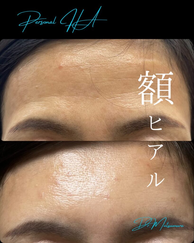 額のヒアルロン酸の症例写真 (2)