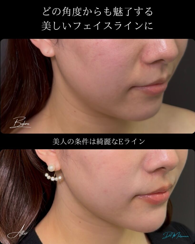 顔の脂肪吸引と顎のヒアルロン酸の症例写真 (2)