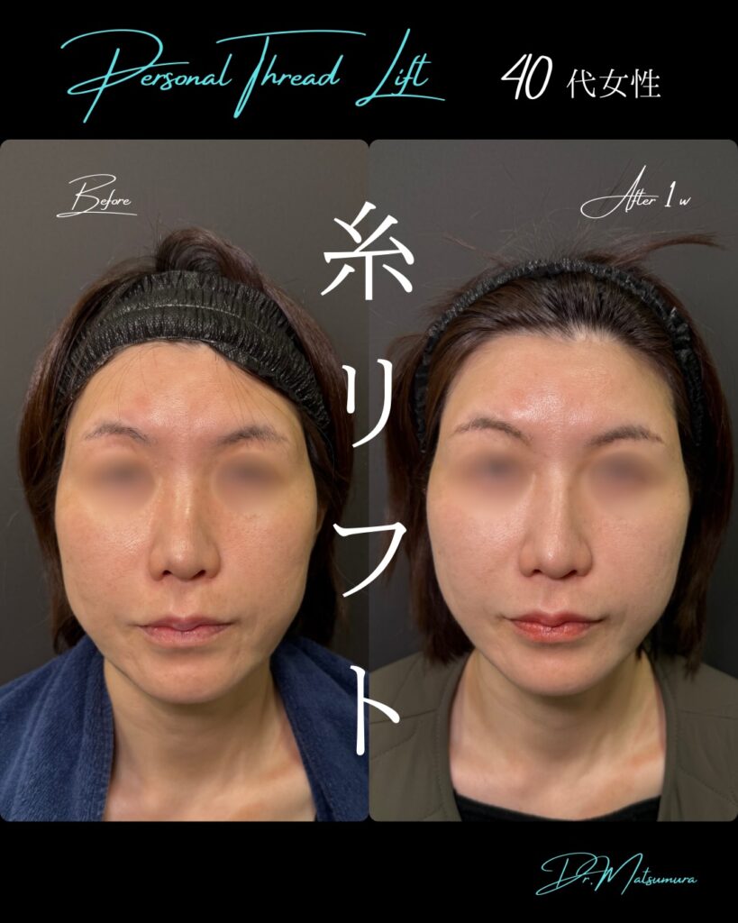 糸リフトの症例写真 (7)