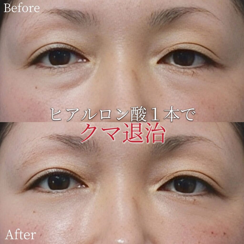 目の下のヒアルロン酸の症例写真