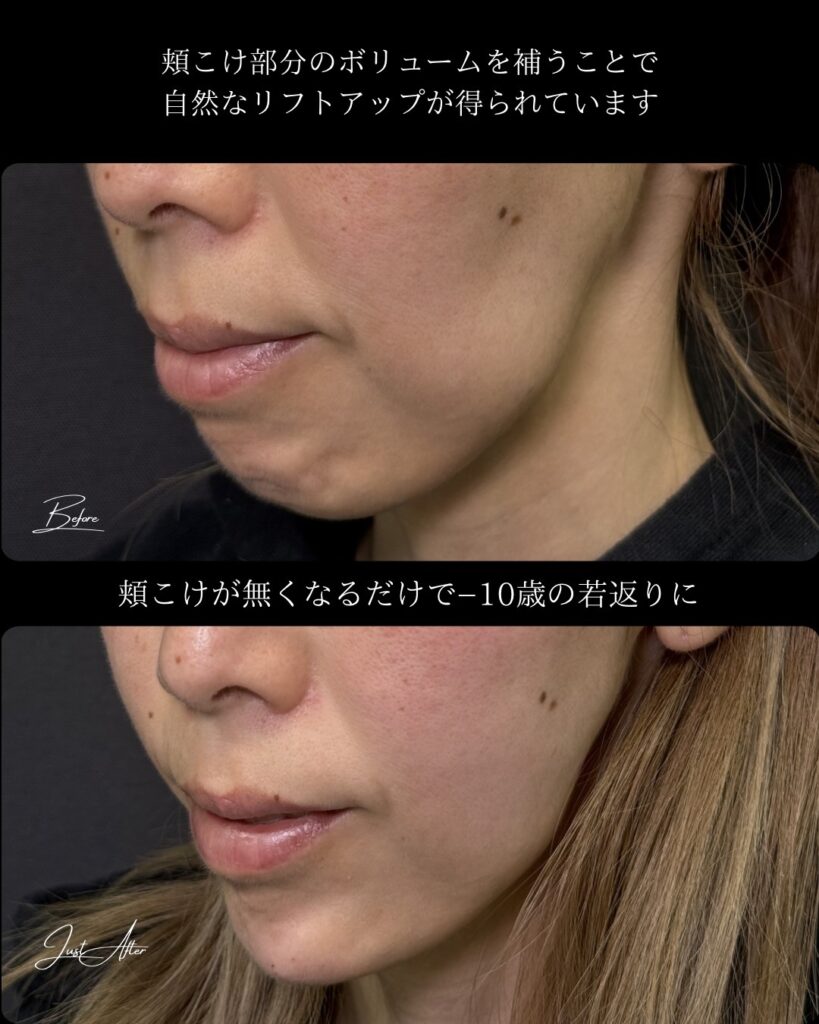 頬とこめかみと顎と目の上のヒアルロン酸の症例写真 (2)