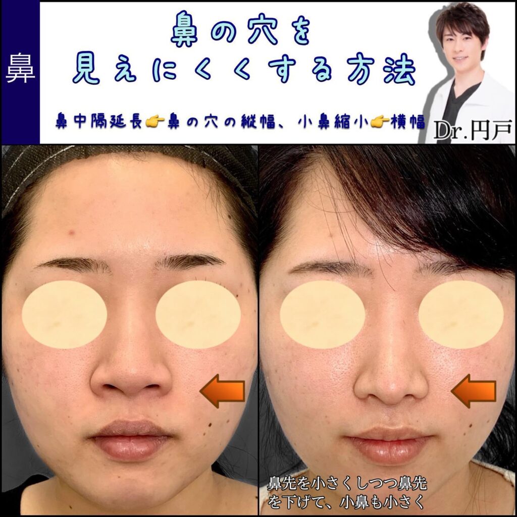 鼻中隔延長と小鼻縮小の症例写真