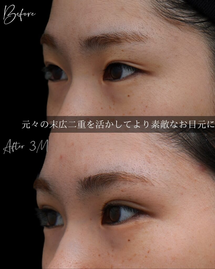 埋没法の症例写真 (12)