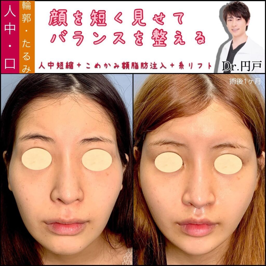 糸リフトと人中短縮とこめかみと額の脂肪注入の症例写真