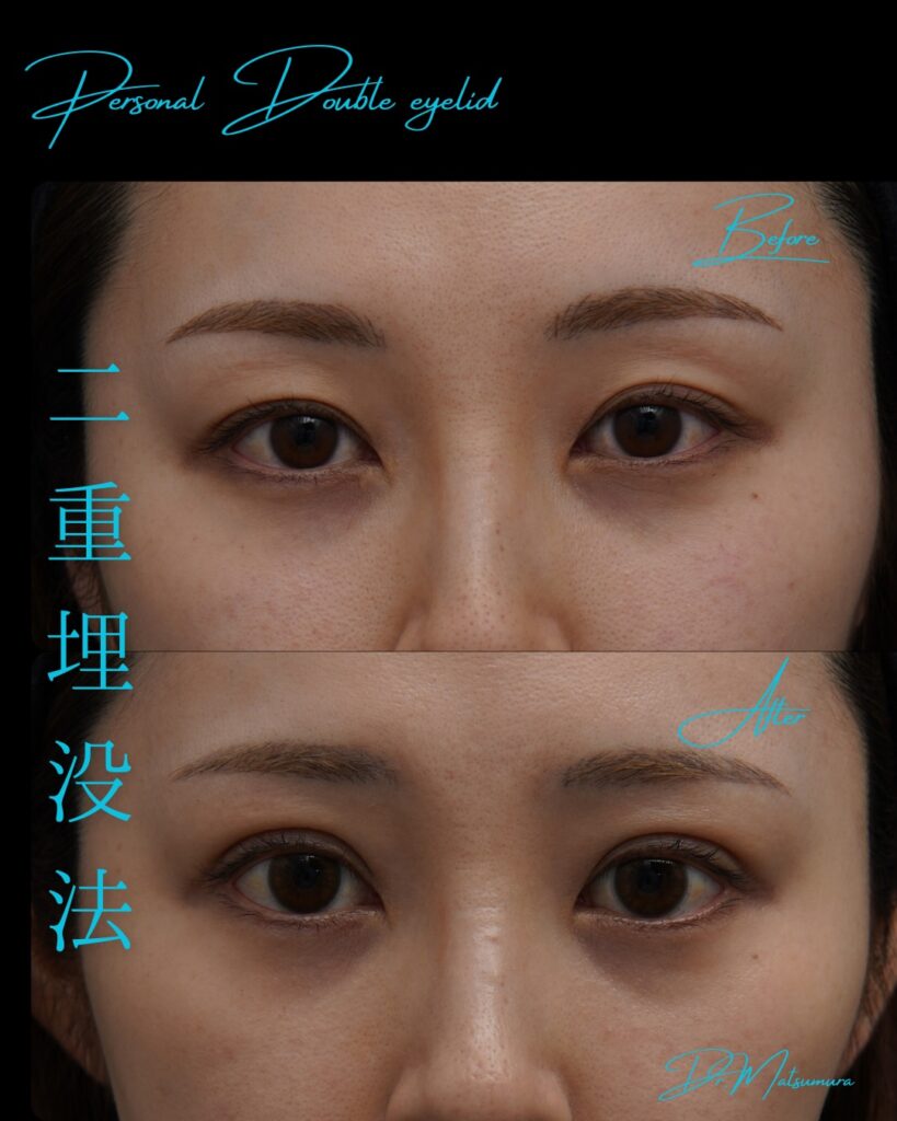 埋没法の症例写真 (8)