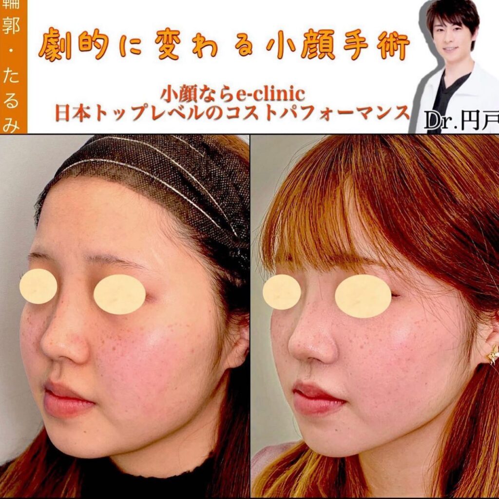 顔の脂肪吸引の症例写真