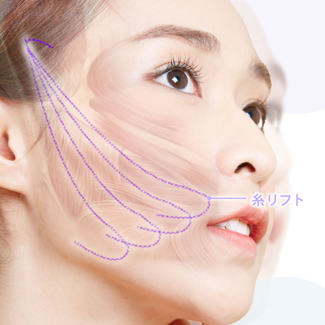 糸リフトの図解