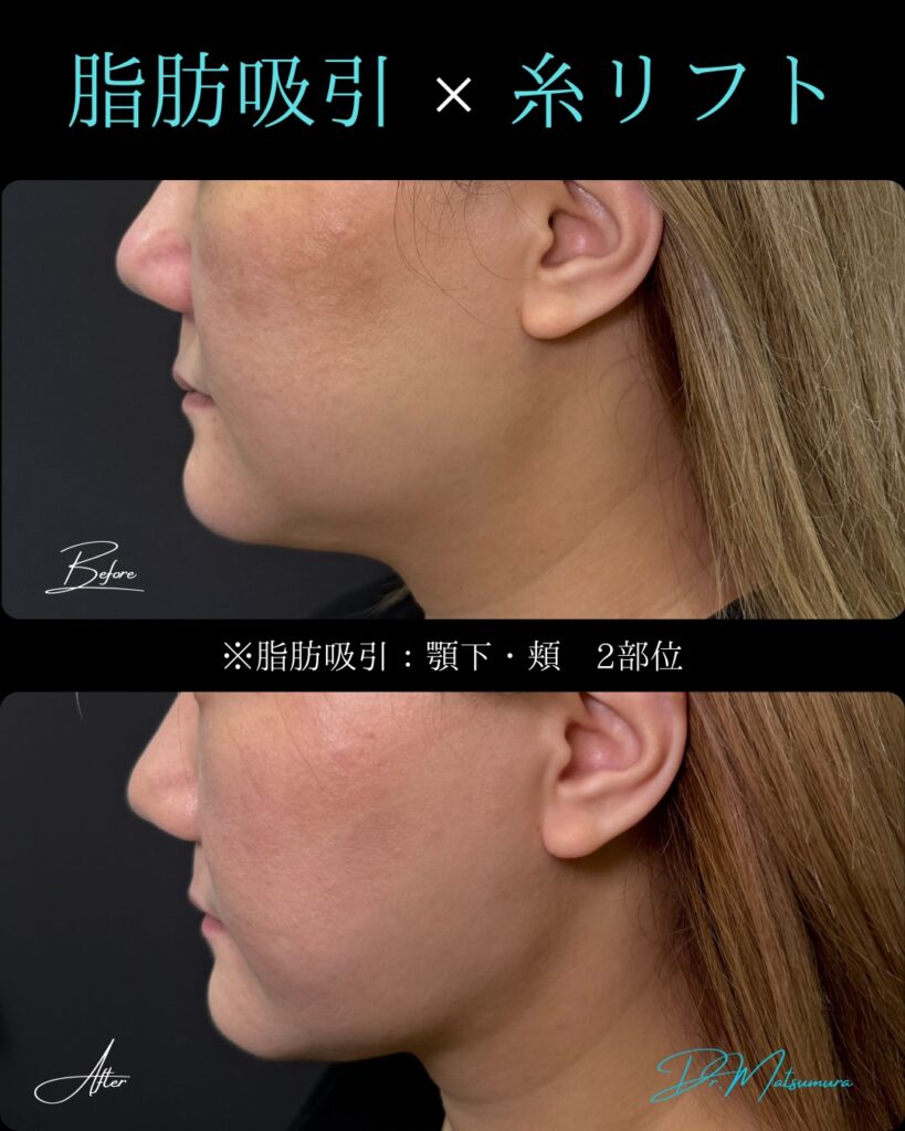 顔の脂肪吸引と糸リフトの症例写真 (8)