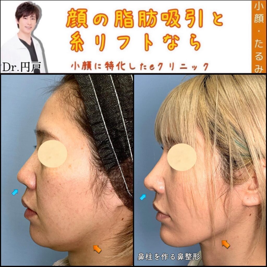 顔の脂肪吸引と糸リフトの症例写真 (8)