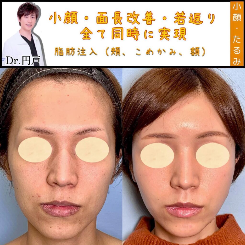 脂肪注入の症例写真 (2)