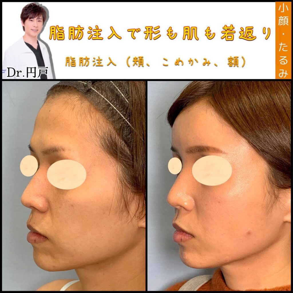 脂肪注入の症例写真