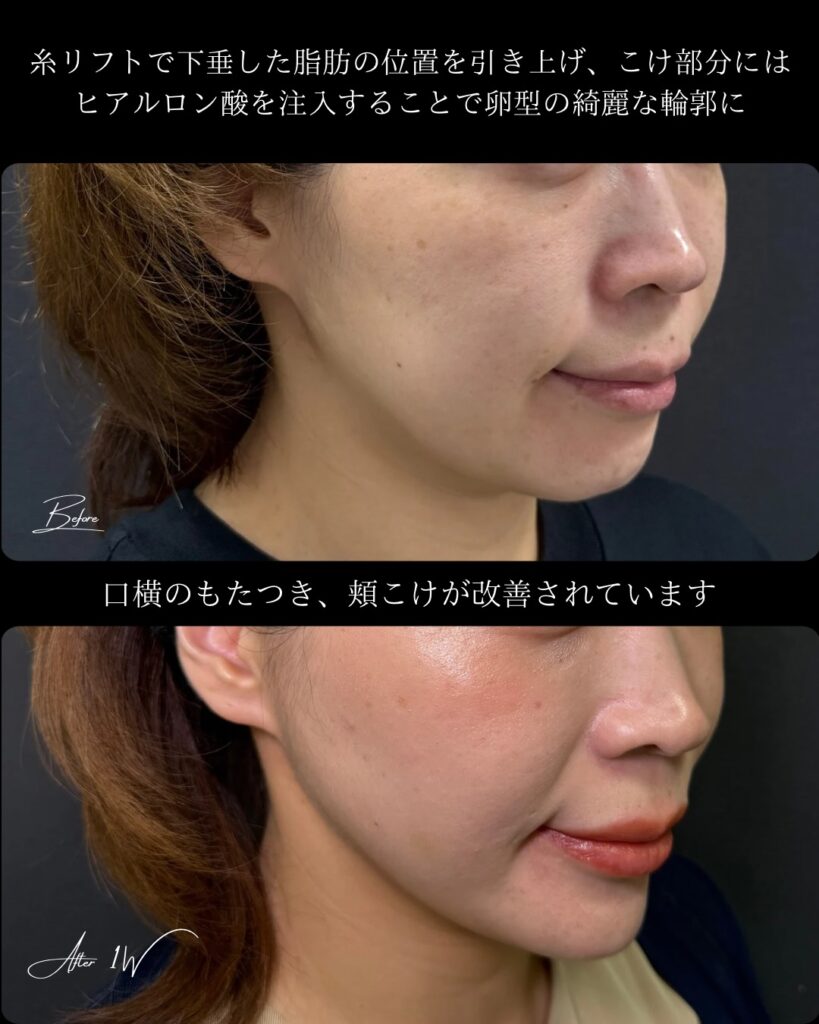 糸リフトの症例写真 (9)