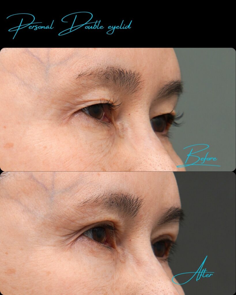 埋没法の症例写真 (7)