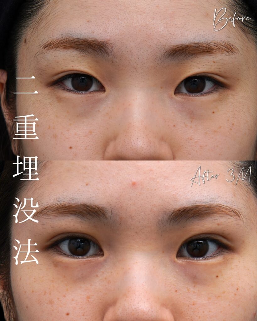 埋没法の症例写真 (7)
