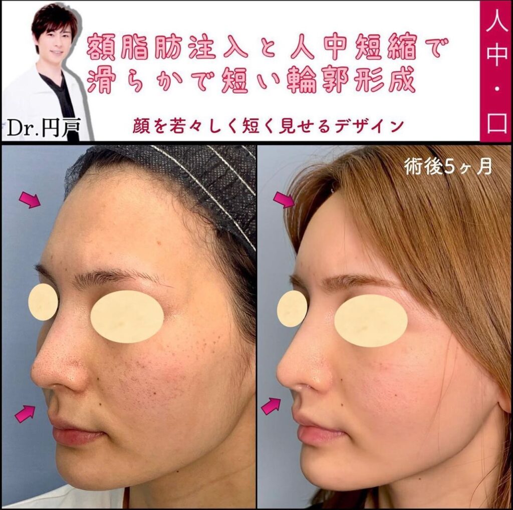 額の脂肪注入と人中短縮の諸例写真