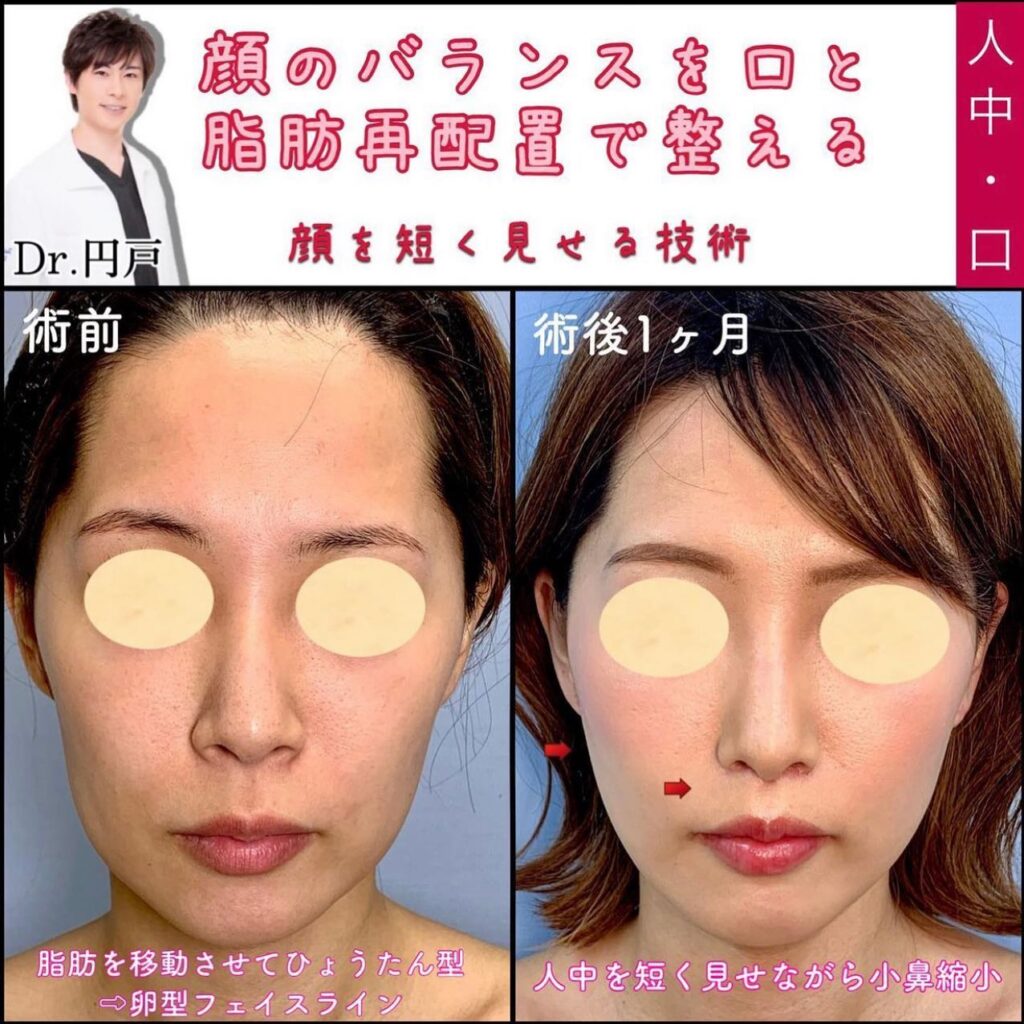 人中短縮と脂肪注入と糸リフトの症例写真