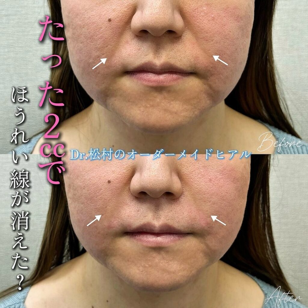 ほうれい線のヒアルロン酸の症例写真