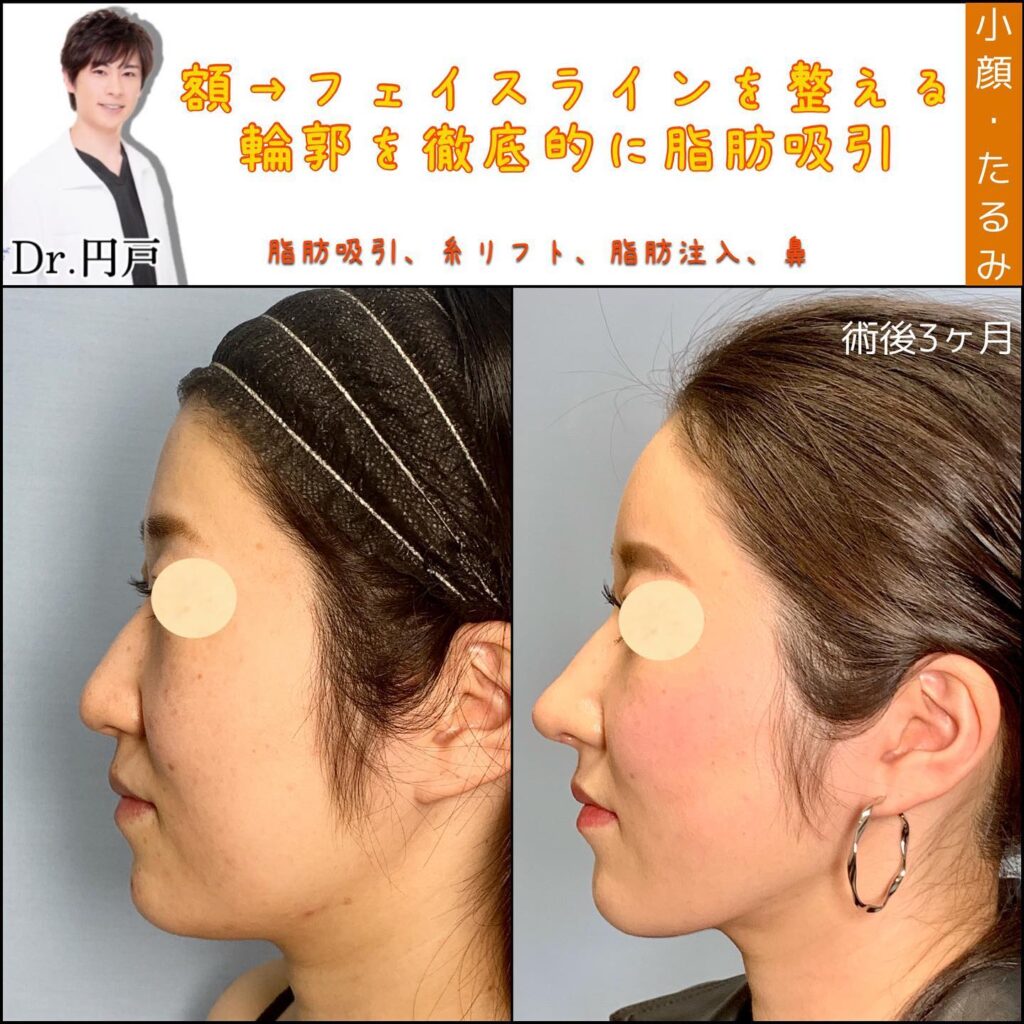 顔の脂肪吸引と糸リフトと脂肪注入と鼻の美容整形の症例写真