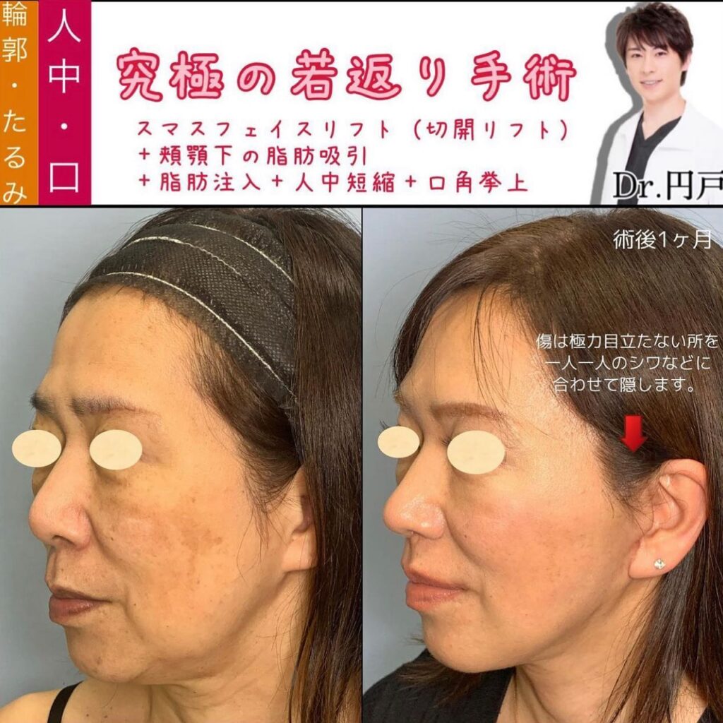 フェイスリフトと頬と顎下の脂肪吸引と脂肪注入と人中短縮と口角挙上の症例写真