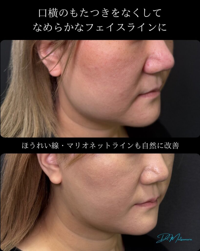 顔の脂肪吸引と糸リフトの症例写真 (7)