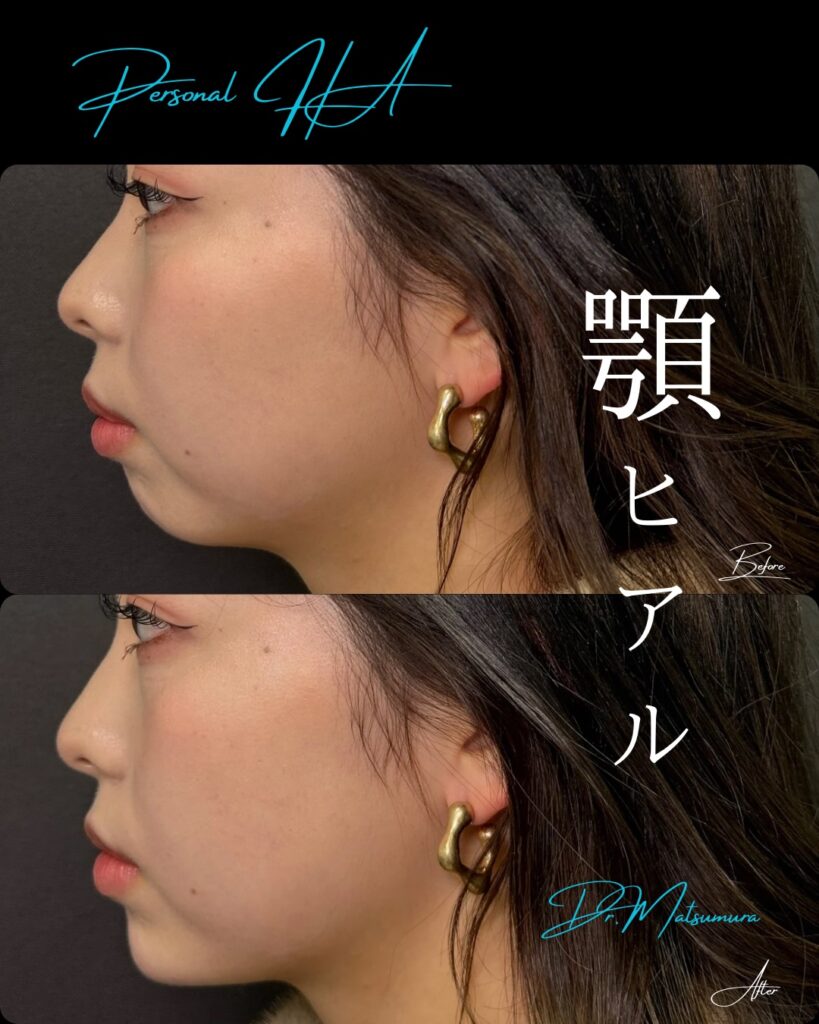 顎のヒアルロン酸の症例写真 (2)