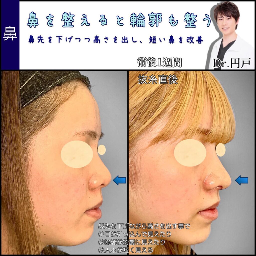 鼻中隔延長と軟骨移植と鼻尖形成の症例写真