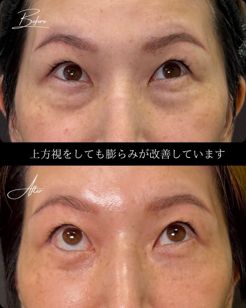 裏ハムラ法の症例写真 (20)