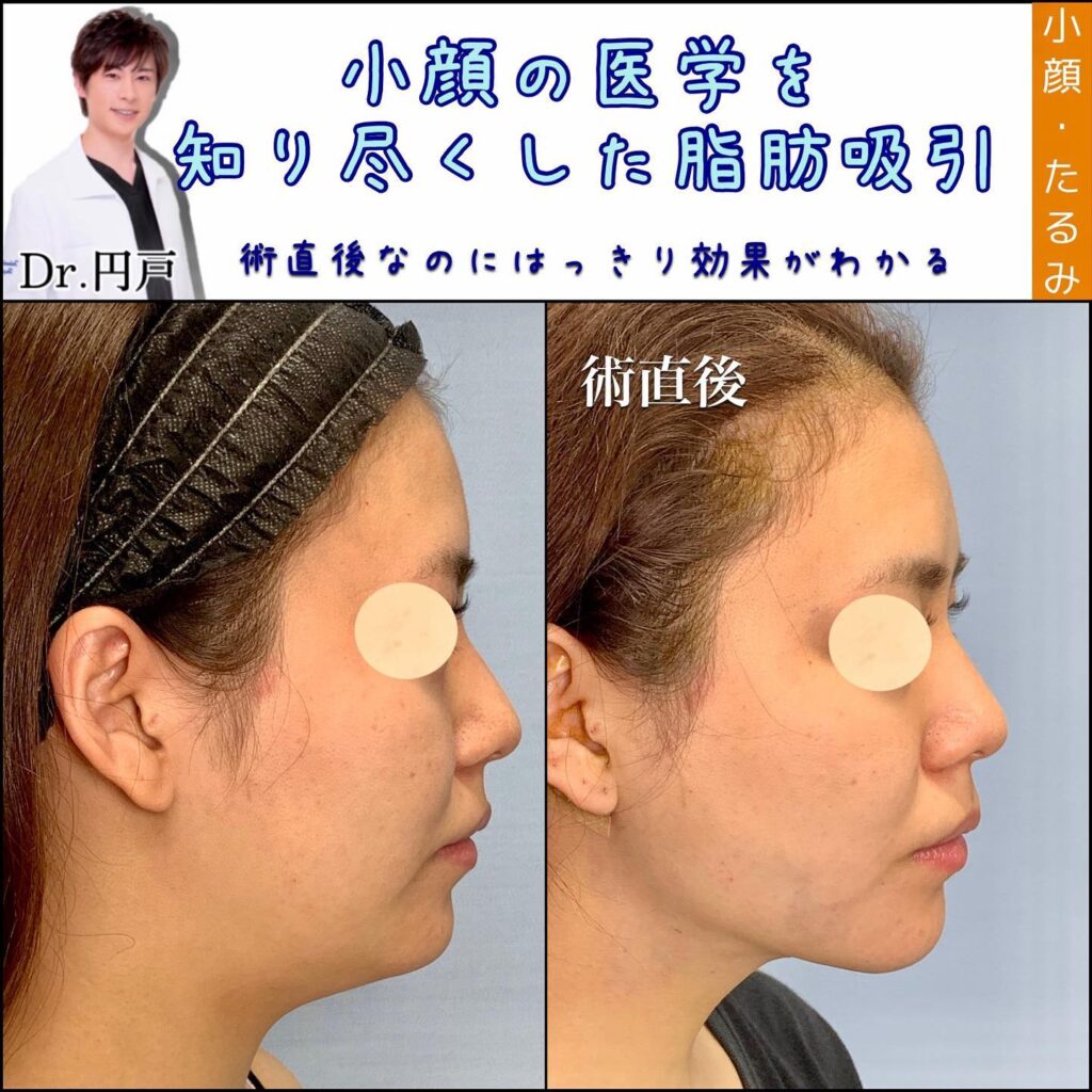 顔の脂肪吸引の症例写真 (2)