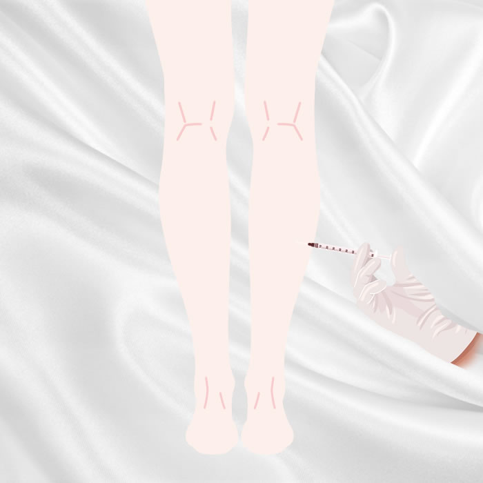 ふくらはぎボトックスのアイコン