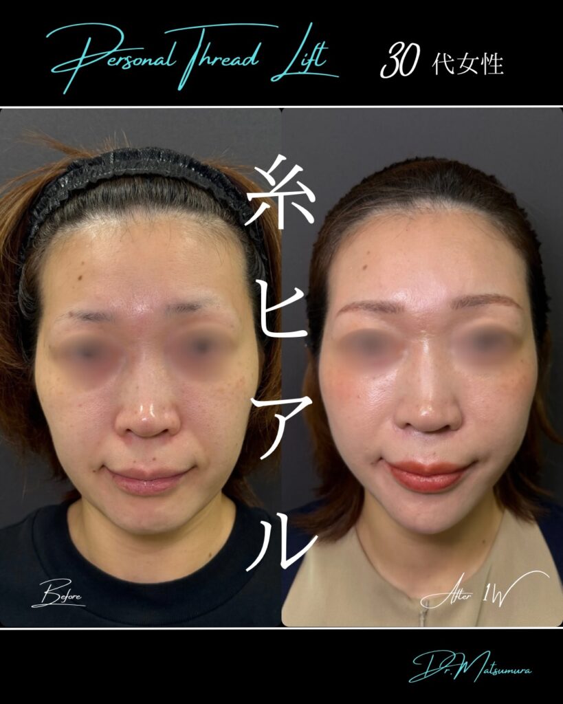 糸リフトの症例写真 (10)