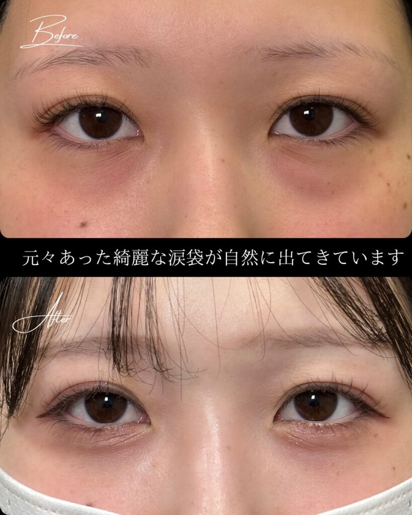 裏ハムラ法の症例写真 (22)